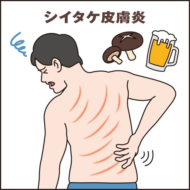 【写真】【健康】シイタケ皮膚炎 よく火を通して食べて 十勝毎日新聞電子版－tokachi Mainichi News Web 